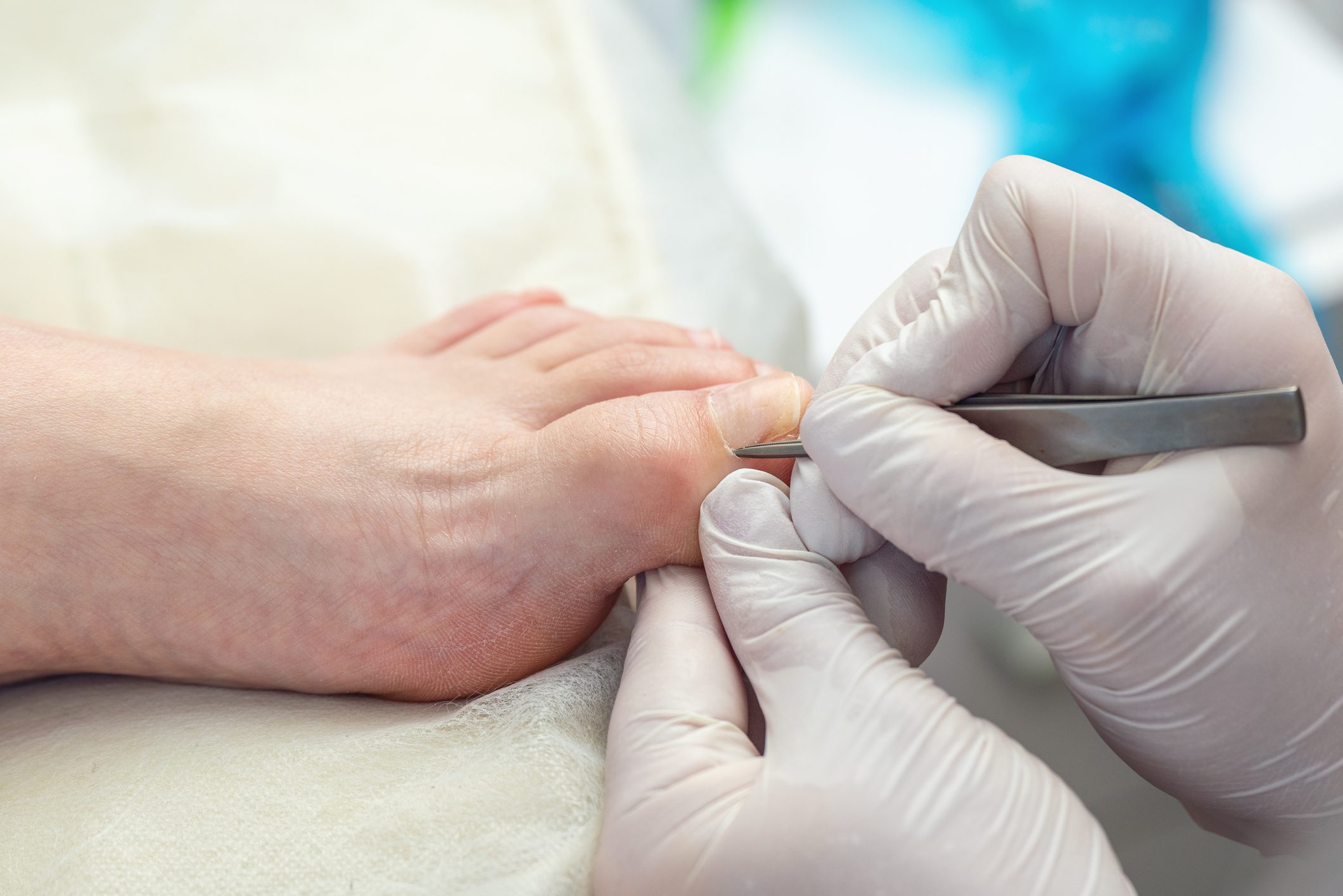 A podiatrist uses tweezers to remove a callus on a toe.