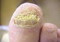 fungal nail infection podiatrist brisbane